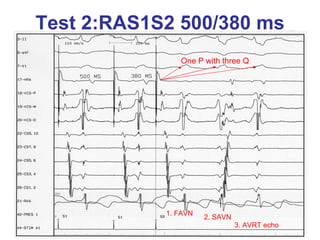 Test 2:RAS1S2 500/380 ms
               One P with three Q




            1. FAVN
                      2. SAVN
                                3. AVRT echo
 