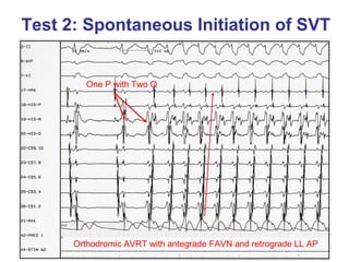 Test 2: Spontaneous Initiation of SVT


        One P with Two Q




      Orthodromic AVRT with antegrade FAVN and retrograde LL AP
 