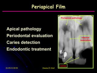 Periapical Film

                                       Periapical pathology




Apical pathology
Periodontal evaluation                                    internal
                                                         resorption
Caries detection
Endodontic treatment


                                       caries
01/25/13 00:59       Ossama El-Shall
 