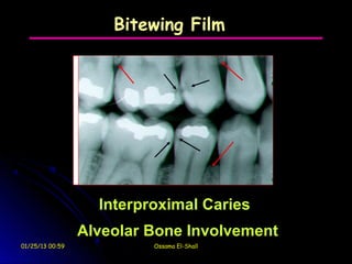 Bitewing Film




                   Interproximal Caries
                 Alveolar Bone Involvement
01/25/13 00:59            Ossama El-Shall
 