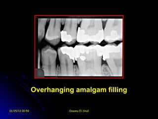 Overhanging amalgam filling

01/25/13 00:59             Ossama El-Shall
 