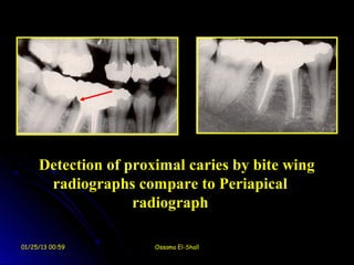 Detection of proximal caries by bite wing
      radiographs compare to Periapical
                   radiograph

01/25/13 00:59        Ossama El-Shall
 