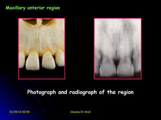 Maxillary anterior region




             Photograph and radiograph of the region


 01/25/13 00:59             Ossama El-Shall
 
