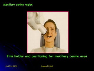 Maxillary canine region




  Film holder and positioning for maxillary canine area


 01/25/13 00:59           Ossama El-Shall
 