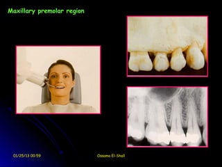 Maxillary premolar region




 01/25/13 00:59             Ossama El-Shall
 