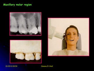 Maxillary molar region




 01/25/13 00:59          Ossama El-Shall
 