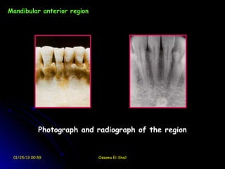 Mandibular anterior region




             Photograph and radiograph of the region


 01/25/13 00:59              Ossama El-Shall
 