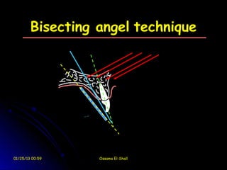 Bisecting angel technique




01/25/13 00:59    Ossama El-Shall
 