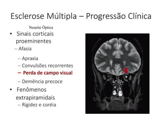 – Rigidez e coréia
– Apraxia
– Convulsões recorrentes
– Demência precoce
• Fenômenos
extrapiramidais
Esclerose Múltipla – Progressão Clínica
Neurite Óptica
• Sinais corticais
proeminentes
– Afasia
 