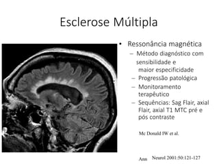 sensibilidade e
Neurol 2001:50:121-127
Esclerose Múltipla
• Ressonância magnética
– Método diagnóstico com
maior especificidade
– Progressão patológica
– Monitoramento
terapêutico
– Sequências: Sag Flair, axial
Flair, axial T1 MTC pré e
pós contraste
Mc Donald IW et al.
Ann
 