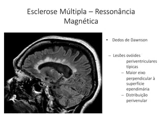Esclerose Múltipla – Ressonância
Magnética
• Dedos de Dawnson
– Lesões ovóides
periventriculares
típicas
– Maior eixo
perpendicular à
superfície
ependimária
– Distribuição
perivenular
 