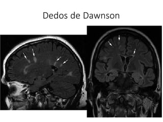 Dedos de Dawnson
 