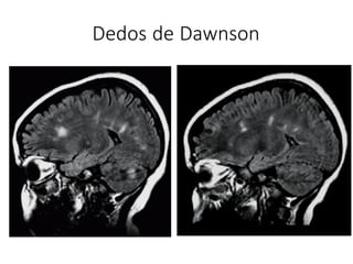 Dedos de Dawnson
 