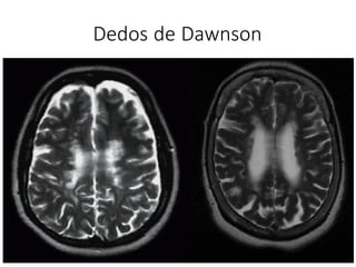 Dedos de Dawnson
 