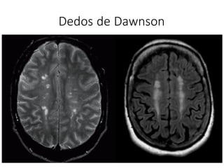 Dedos de Dawnson
 