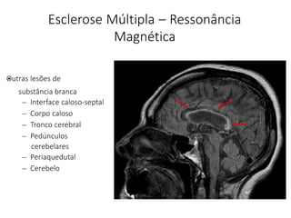Esclerose Múltipla – Ressonância
Magnética
•
substância branca
– Interface caloso-septal
– Corpo caloso
– Tronco cerebral
– Pedúnculos
cerebelares
– Periaquedutal
– Cerebelo
Outras lesões de
 