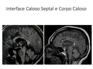 Interface Caloso Septal e Corpo Caloso
 