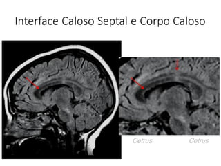 Interface Caloso Septal e Corpo Caloso
Cetrus Cetrus
 