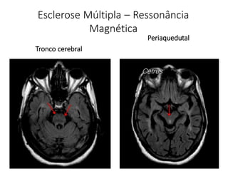 Esclerose Múltipla – Ressonância
Magnética
Tronco cerebral
Periaquedutal
Cetrus
 