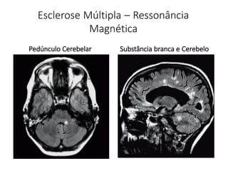 Esclerose Múltipla – Ressonância
Magnética
Pedúnculo Cerebelar Substância branca e Cerebelo
 
