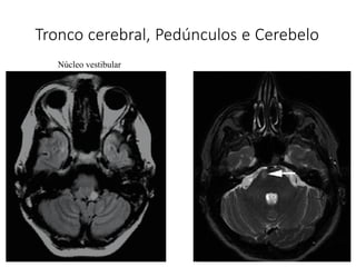 Tronco cerebral, Pedúnculos e Cerebelo
Núcleo vestibular
 