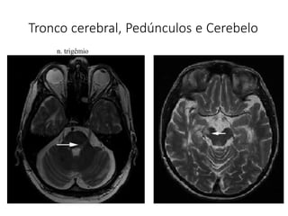 Tronco cerebral, Pedúnculos e Cerebelo
n. trigêmio
 