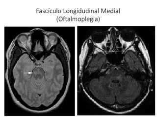 Fascículo Longidudinal Medial
(Oftalmoplegia)
 