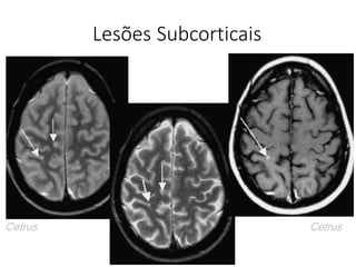 Lesões Subcorticais
Cetrus Cetrus
 
