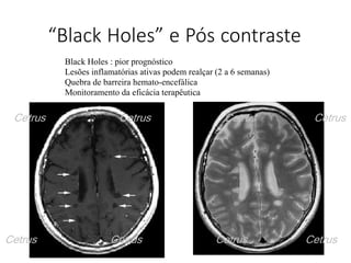 “Black Holes” e Pós contraste
Black Holes : pior prognóstico
Lesões inflamatórias ativas podem realçar (2 a 6 semanas)
Quebra de barreira hemato-encefálica
Monitoramento da eficácia terapêutica
Cetrus Cetrus Cetrus Cetrus
Cetrus Cetrus Cetrus Cetrus
 