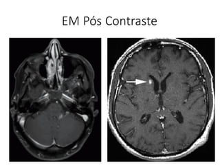 EM Pós Contraste
 