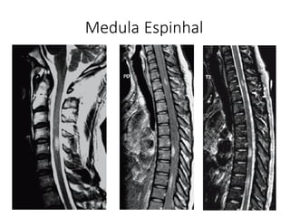 Medula Espinhal
 