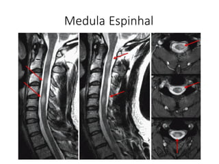 Medula Espinhal
 