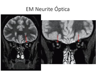 EM Neurite Óptica
 