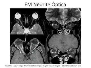 EM Neurite Óptica
Encéfalo – Série Colégio Brasileiro de Radiologia e Diagnóstico por Imagem – 2012 Elsevier Editora Ltda
 
