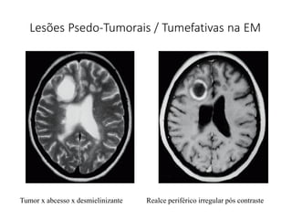 Lesões Psedo-Tumorais / Tumefativas na EM
Tumor x abcesso x desmielinizante Realce periférico irregular pós contraste
 