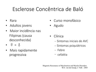 Esclerose Concêntrica de Baló
• Rara
• Adultos jovens
• Maior incidência nas
Filipinas (causa
desconhecida)
• ♀ = ♂
• Mais rapidamente
progressiva
• Curso monofásico
• Agudo
• Clínica
– Sintomas iniciais de AVC
– Sintomas psiquiátricos
–
–
Febre
cefaléia
Magnetic Resonance of Myelination and Myelin Disorders
M.S. van der knaap, J. Valk - 2005
 