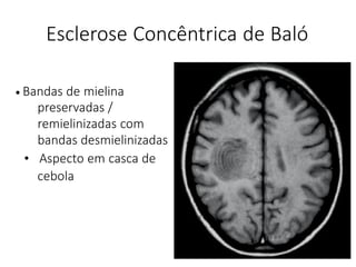 Esclerose Concêntrica de Baló
• Bandas de mielina
preservadas /
remielinizadas com
bandas desmielinizadas
• Aspecto em casca de
cebola
 