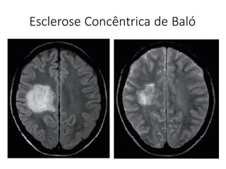 Esclerose Concêntrica de Baló
 