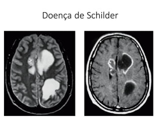 Doença de Schilder
 