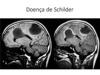 Doença de Schilder
 