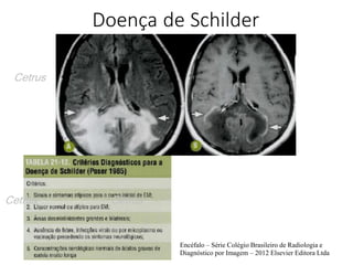 Doença de Schilder
Encéfalo – Série Colégio Brasileiro de Radiologia e
Diagnóstico por Imagem – 2012 Elsevier Editora Ltda
Cetrus
Cetrus Cetrus
 