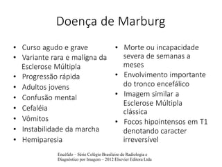 Doença de Marburg
• Curso agudo e grave
• Variante rara e malígna da
Esclerose Múltipla
• Progressão rápida
• Adultos jovens
• Confusão mental
• Cefaléia
• Vômitos
• Instabilidade da marcha
• Hemiparesia
• Morte ou incapacidade
severa de semanas a
meses
• Envolvimento importante
do tronco encefálico
• Imagem similar a
Esclerose Múltipla
clássica
• Focos hipointensos em T1
denotando caracter
irreversível
Encéfalo – Série Colégio Brasileiro de Radiologia e
Diagnóstico por Imagem – 2012 Elsevier Editora Ltda
 
