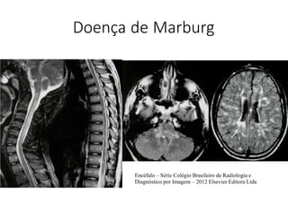 Doença de Marburg
Encéfalo – Série Colégio Brasileiro de Radiologia e
Diagnóstico por Imagem – 2012 Elsevier Editora Ltda
 