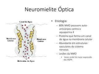 Neuromielite Óptica
• Etiologia:
– 80% NMO possuem auto-
anticorpos contra a
aquaporina 4
– Proteína que forma um canal
de água na membrana celular
– Abundante em estruturas
vasculares do sistema
nervoso.
– Lesões da NMO
• locais onde há maior expressão
das AQP4.
 