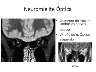 ambos os nervos
Neuromielite Óptica
normal
• Aumento do sinal de
ópticos
• Atrofia do n. Óptico
esquerdo
 