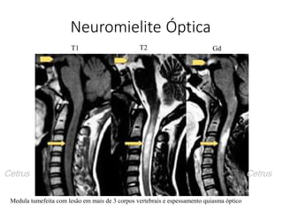 Neuromielite Óptica
Medula tumefeita com lesão em mais de 3 corpos vertebrais e espessamento quiasma óptico
T2 GdT1
Cetrus Cetrus
 