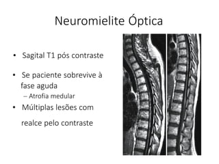 • Sagital T1 pós contraste
realce pelo contraste
Neuromielite Óptica
• Se paciente sobrevive à
fase aguda
– Atrofia medular
• Múltiplas lesões com
 
