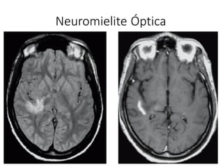 Neuromielite Óptica
 