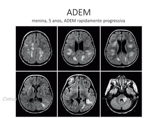 ADEM
menina, 5 anos, ADEM rapidamente progressiva
Cetrus
 