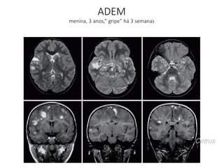 ADEM
menina, 3 anos,” gripe” há 3 semanas
Cetrus
 